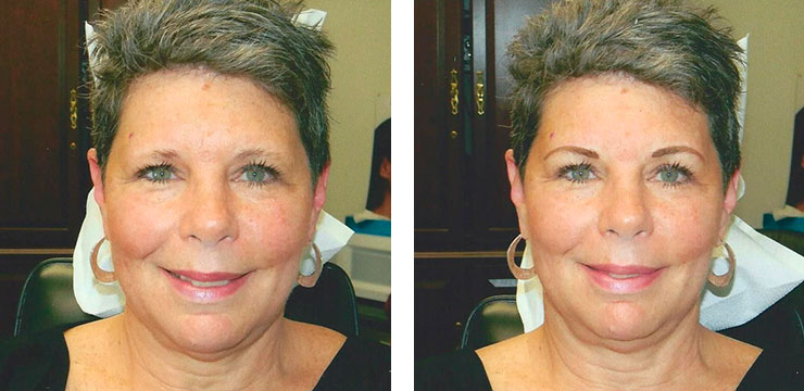 Before and After - Eyebrows