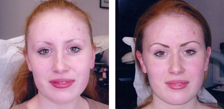 Before and After - Eyebrows