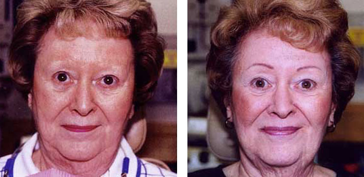 Before and After - Eyebrows