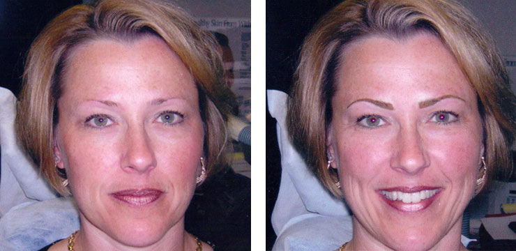 Before and After - Eyebrows