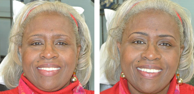 Before and After - Eyebrows